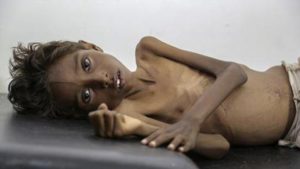 Yemen’s children starve as war drags on