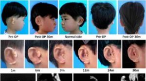 In World First, Children Given New Ears Grown From Their Own Cells